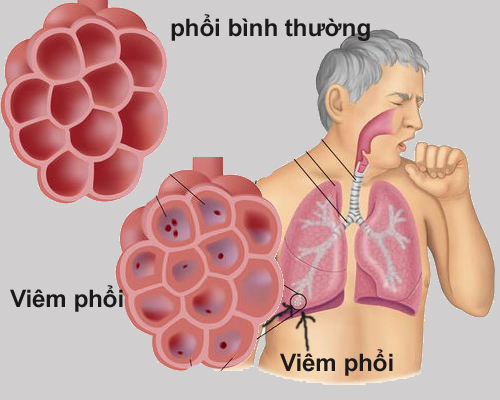 Viêm phổi không điển hình