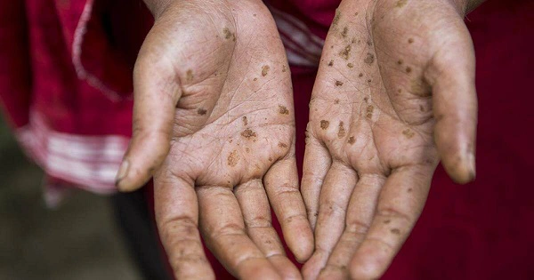 Tác hại của ASEN trong nguồn nước và phương pháp xử lý