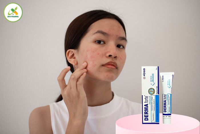 kem trị mụn tốt nhất