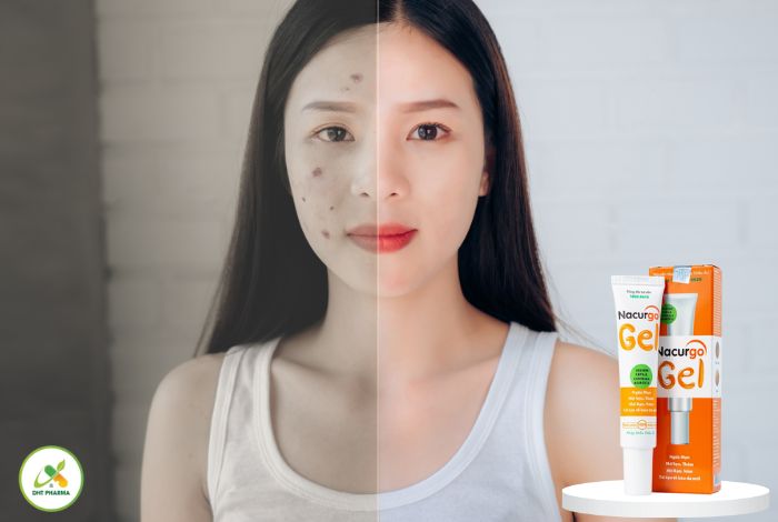 top 5 kem trị thâm mụn