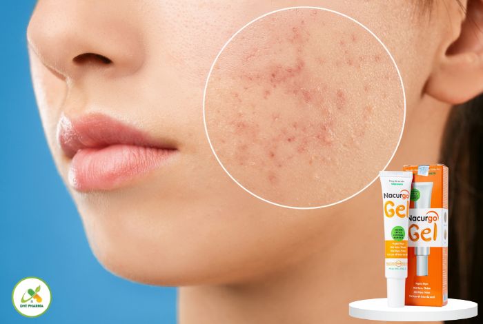 cách trị mụn tại nhà