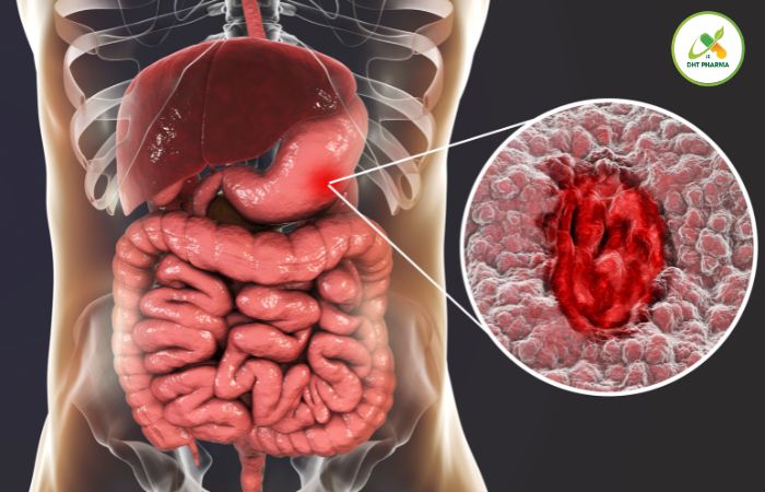 Viêm loét dạ dày