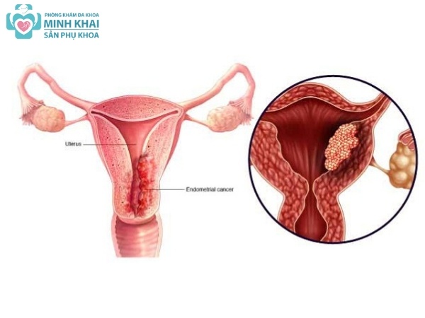 Có thể gây vô sinh ở cả nam và nữ