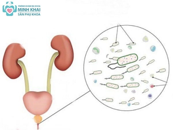 Triệu chứng bệnh Chlamydia ở nam giới