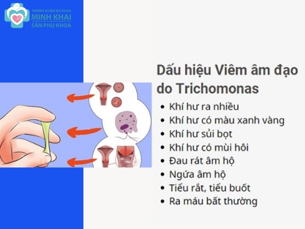 Triệu chứng bệnh Trichomonas vaginalis