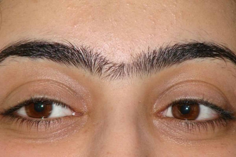 Lông mày bên cao bên thấp