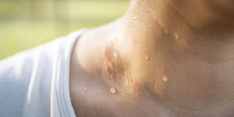 Mồ hôi muối khi tiếp xúc khiến bạc bị đen