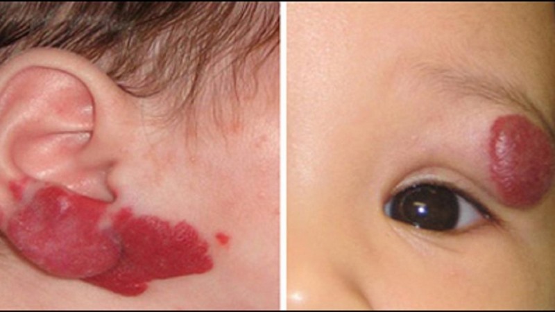 Vết bớt đỏ được xuất hiện từ khi sinh