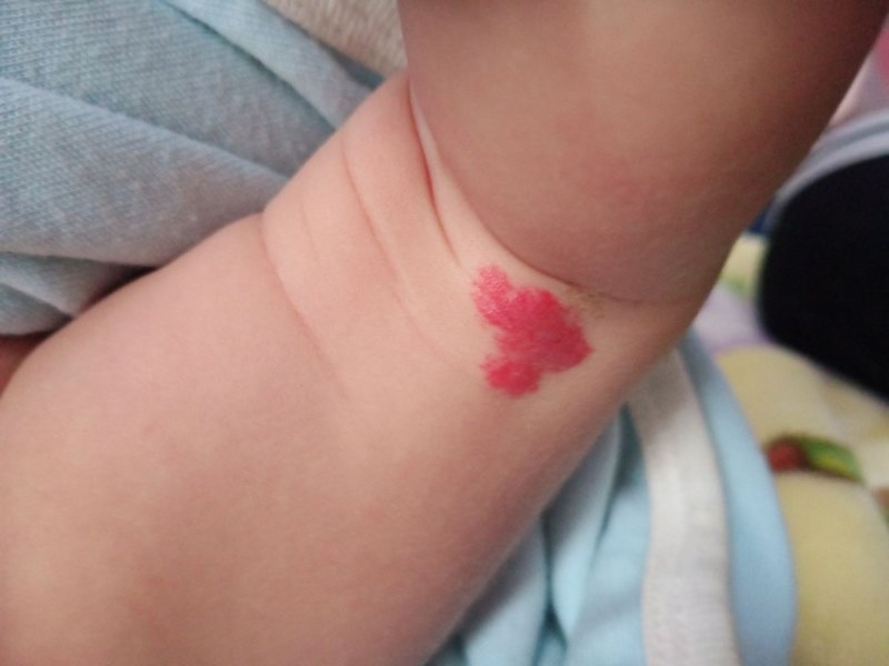 Vết bớt được coi là lành tính, không ảnh hướng sức khỏe