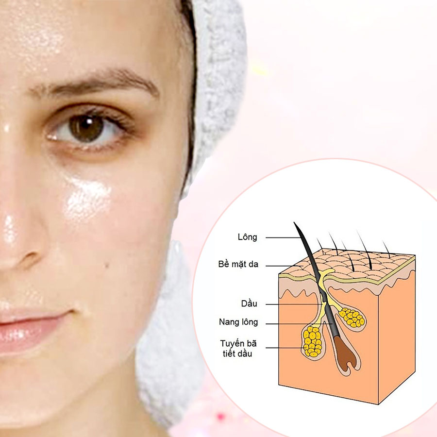 Làn da dầu thường bóng nhờn và cần làm sạch kỹ vào mùa hè