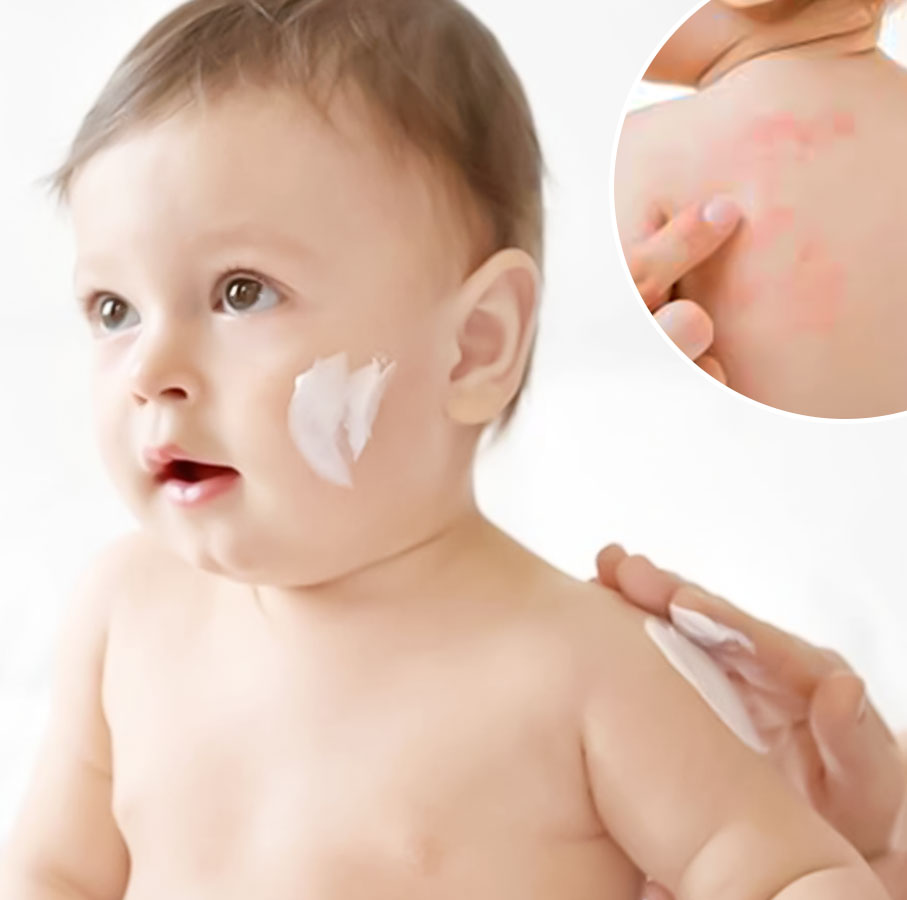 "Làn da bé nhạy cảm dễ bị rôm sảy và kích ứng trong mùa hè