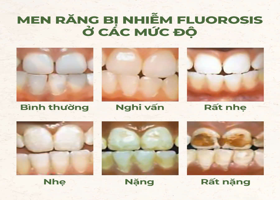 Hình ảnh so sánh men răng khỏe mạnh và men răng bị nhiễm fluorosis ở các mức độ