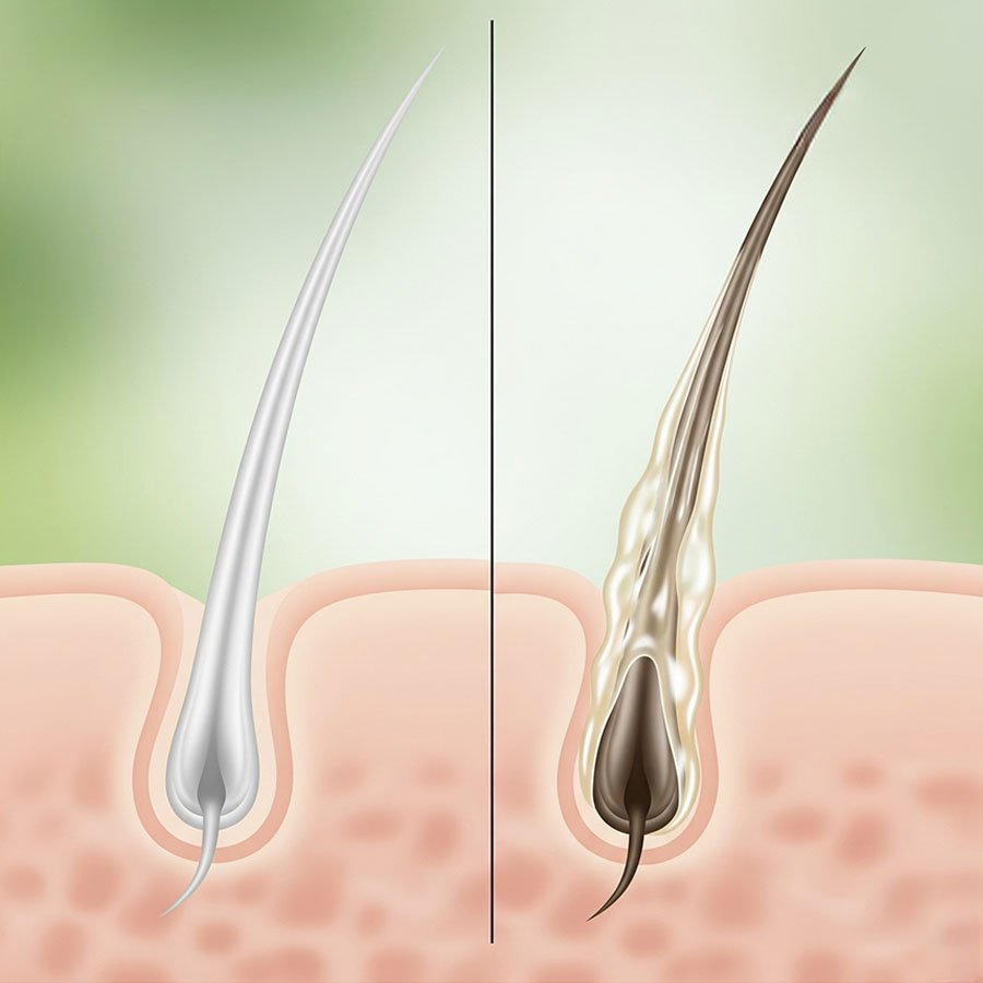 Đồ họa mô tả nguyên nhân da đầu dầu gây bít tắc nang tóc và rụng tóc
