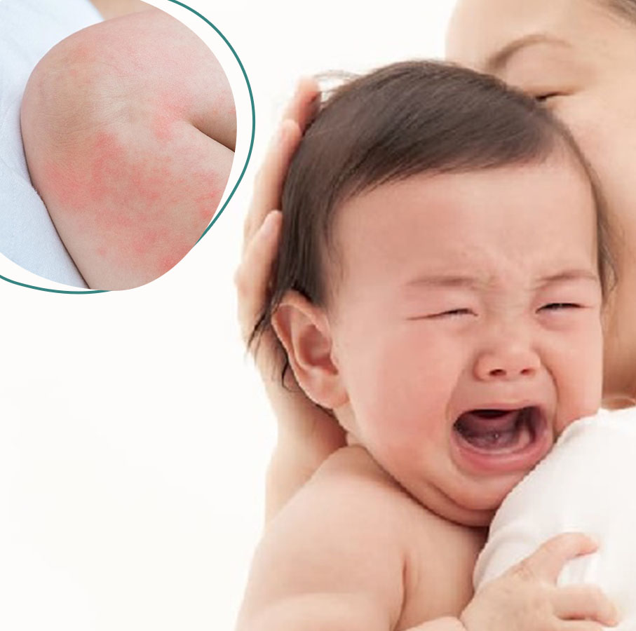 Rôm sảy ở trẻ em vào mùa hè gây khó chịu cho bé
