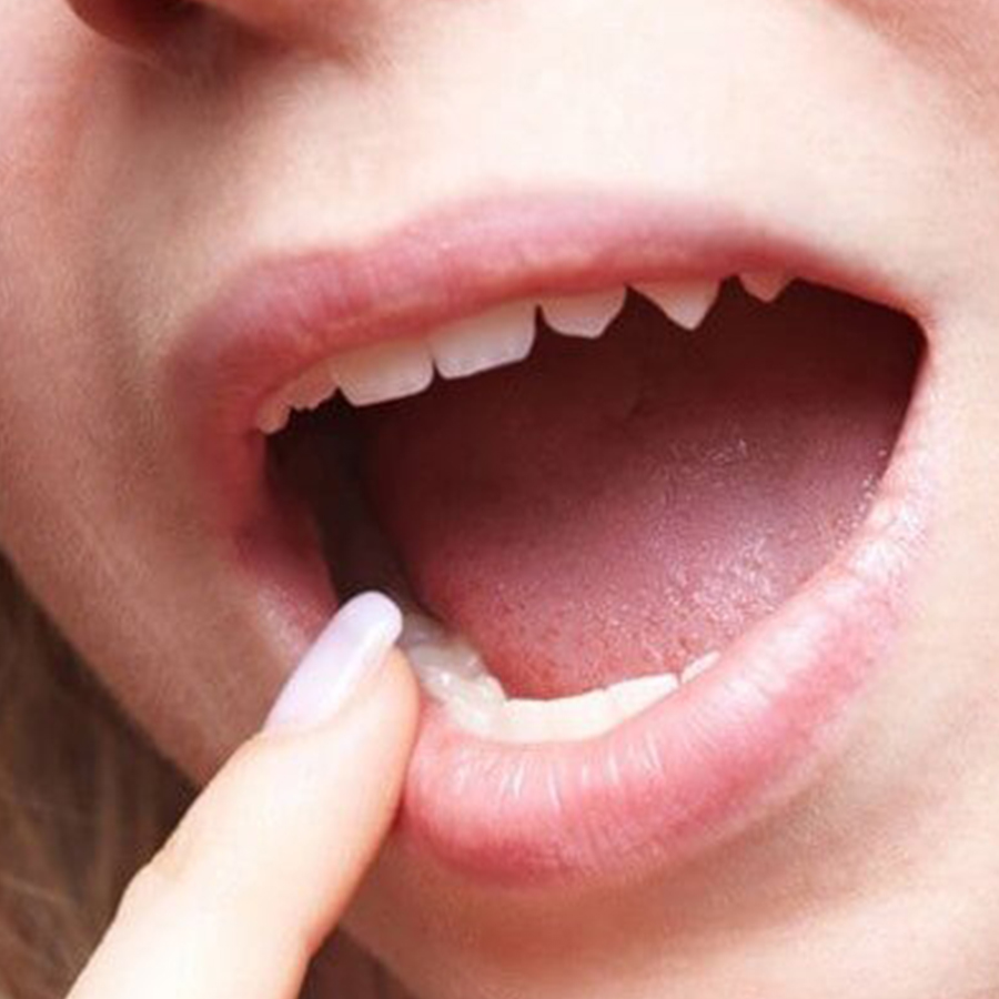 Tác hại của cồn trong nước súc miệng công nghiệp gây khô miệng và hôi miệng