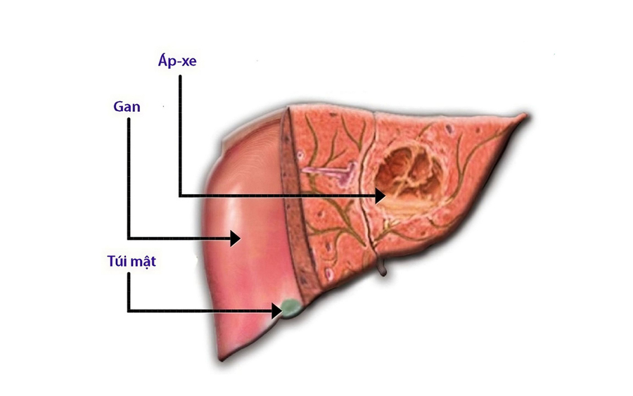 Gan nhiễm mỡ có nguy hiểm không? 5 biến chứng của bệnh gan nhiễm mỡ
