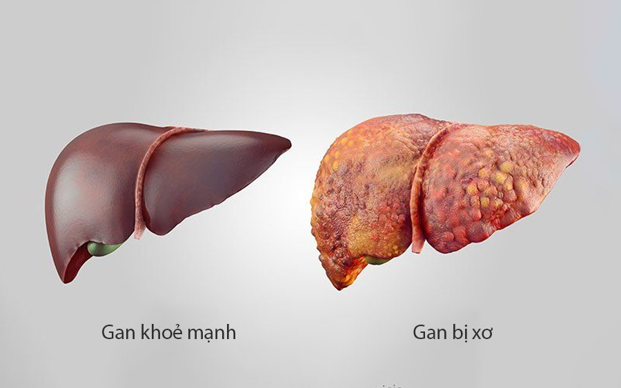 Gan nhiễm mỡ có nguy hiểm không? 5 biến chứng của bệnh gan nhiễm mỡ