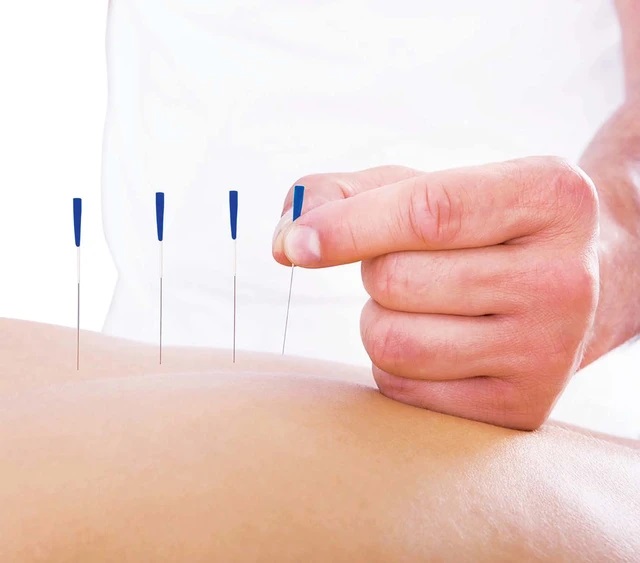 Châm cưu đau khớp vai