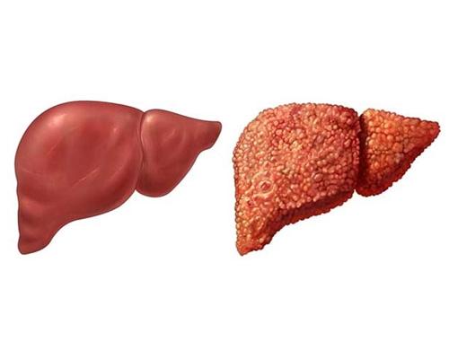 Bệnh gan khô là gì?