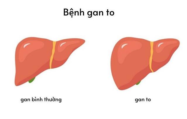 Bệnh gan to