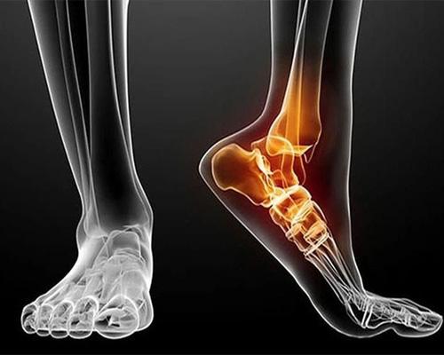 Lật cổ chân là gì?