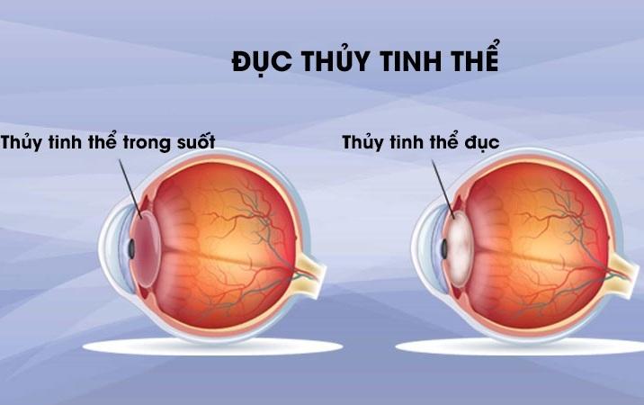 Đục thủy tinh thể