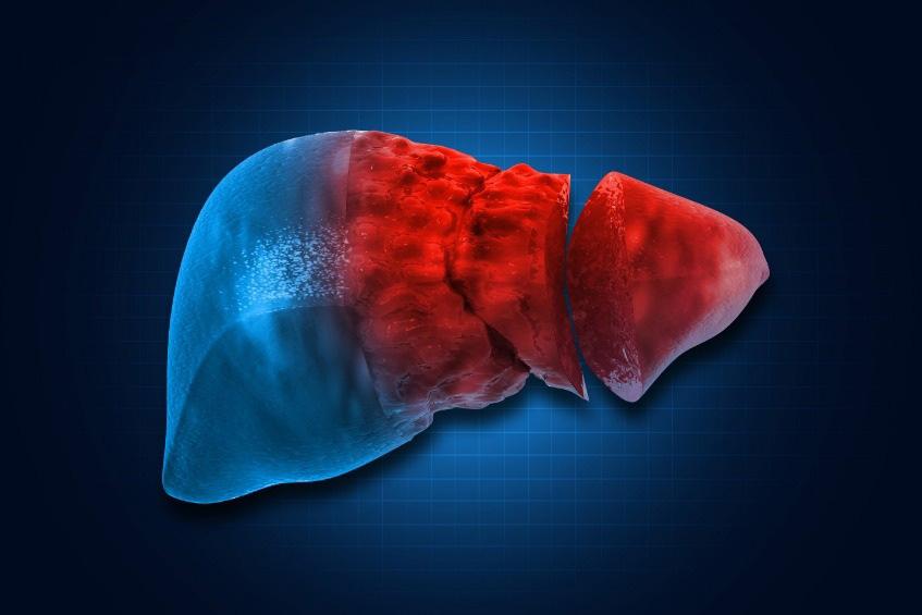 Gan nhiễm mỡ độ 2 có nguy hiểm không