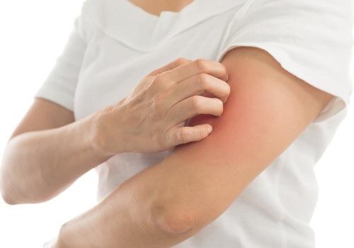 gan nhiễm mỡ gây ngứa không