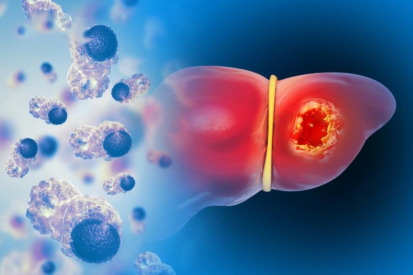 gan nhiễm mỡ trung bình là gì