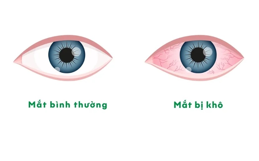 Hội chứng khô mắt nặng