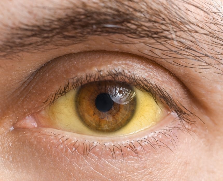 mắt vàng là bệnh gì
