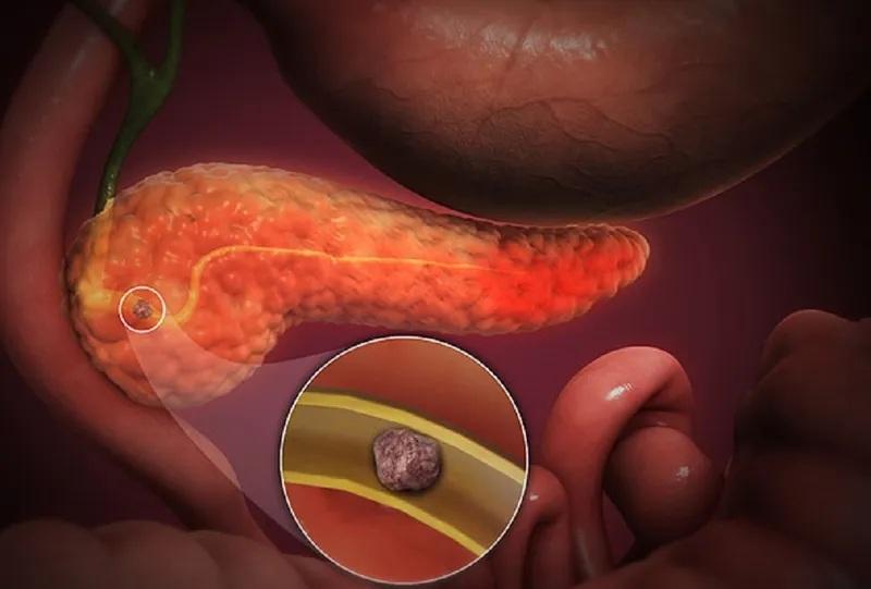 Men tụy cao là gì