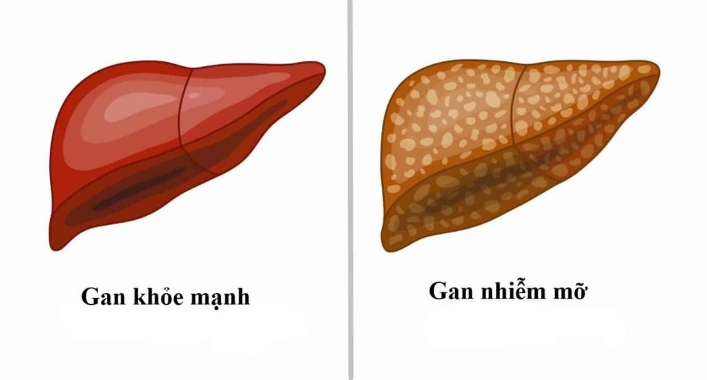 Gan nhiễm mỡ là gì