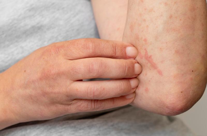 Sẩn ngứa do gan là gì