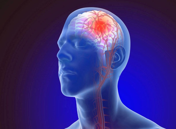 Thiếu máu não là gì?