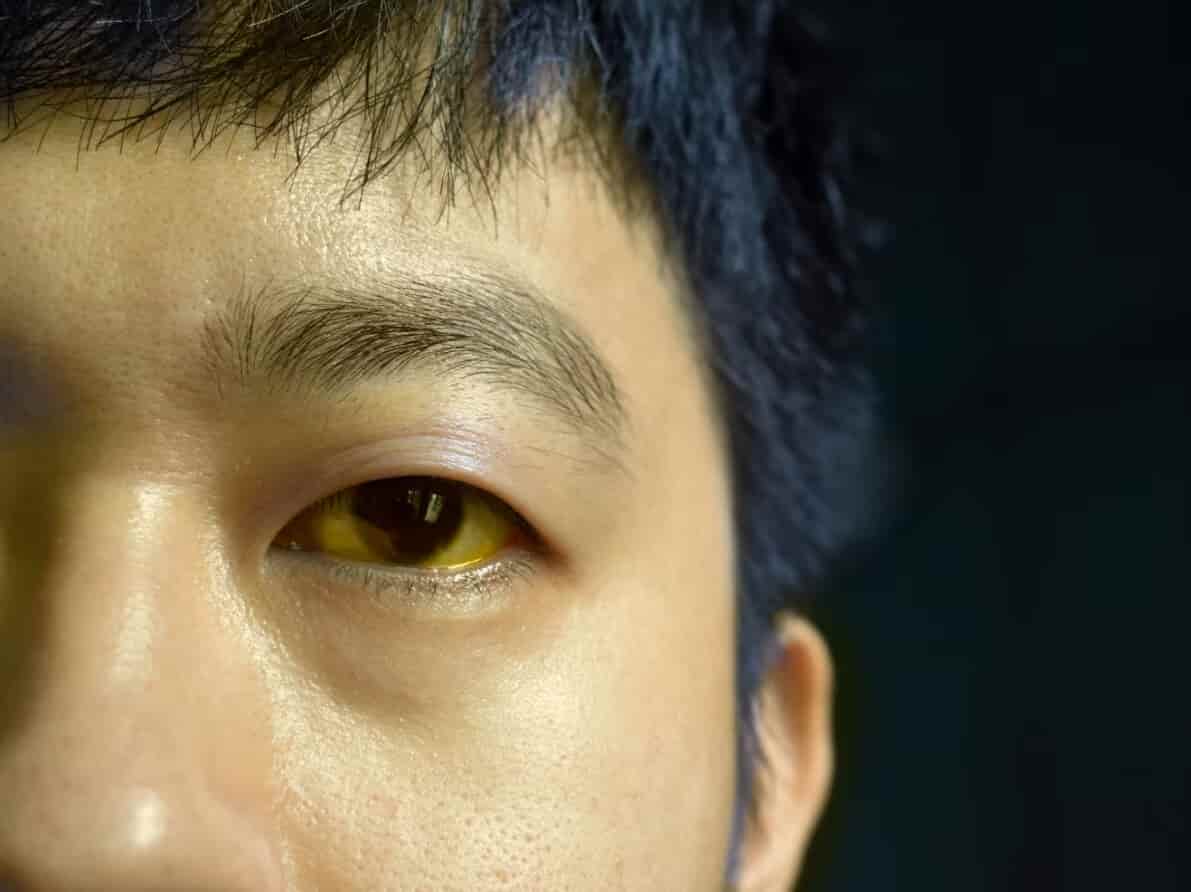 Vàng da vàng mắt