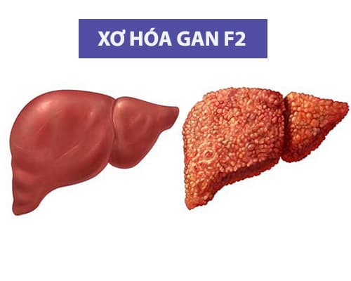 Xơ hóa gan F2