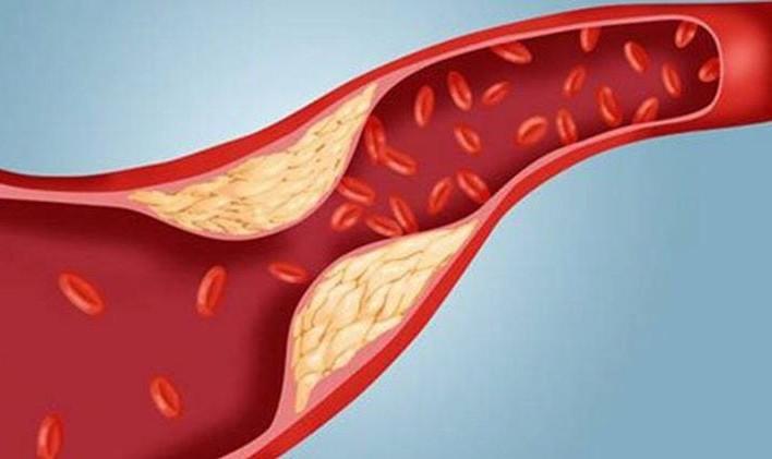 Xơ vữa động mạch