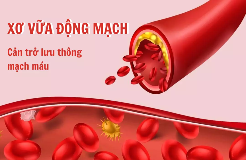Xơ vữa động mạch có hết được không?