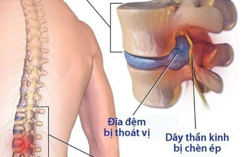 dau-lung-trai-4