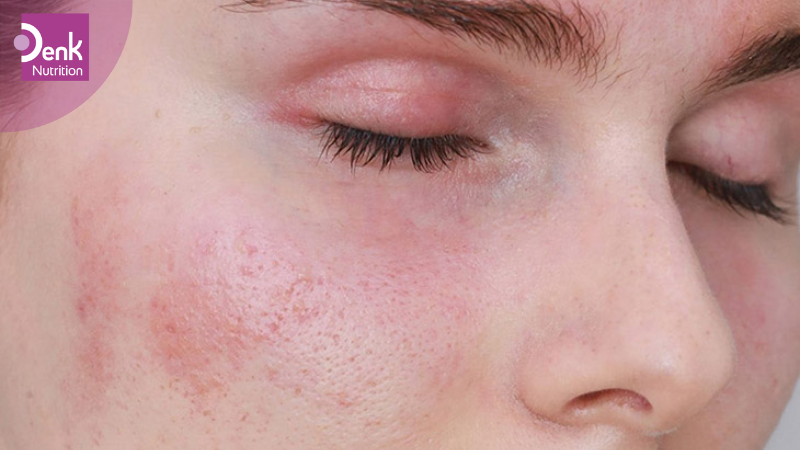 Hỗ trợ bệnh chàm da, mẩn đỏ