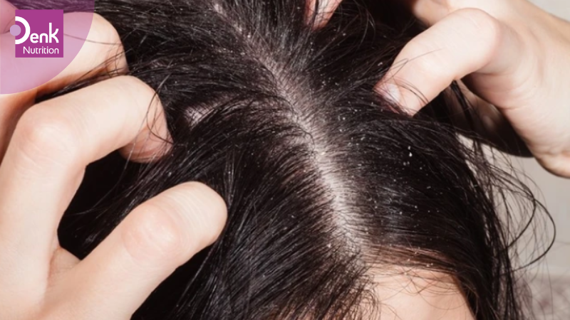 Chống viêm và ngăn ngừa kích ứng da đầu