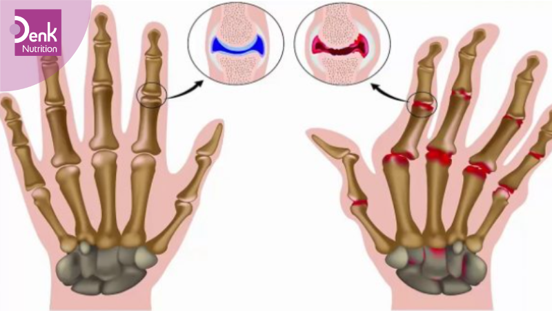 Hỗ trợ điều trị trong viêm khớp dạng thấp