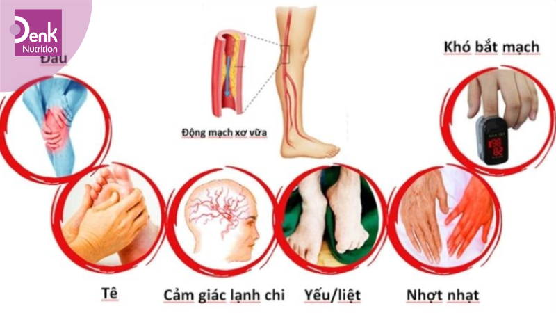 Hỗ trợ điều trị bệnh động mạch ngoại biên