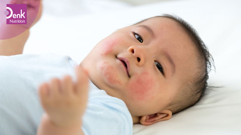 Dị ứng sữa bò là gì?