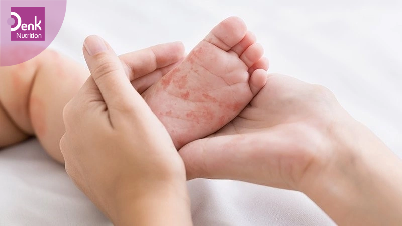 Dấu hiệu trẻ dị ứng đạm bò cha mẹ cần biết