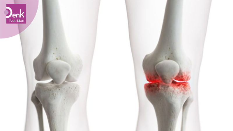 Ngăn ngừa thoái hóa khớp