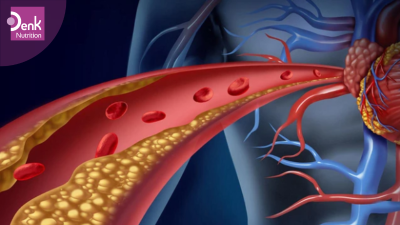Tăng cholesterol máu