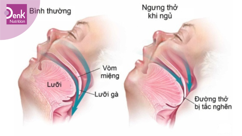 Hội chứng ngưng thở khi ngủ