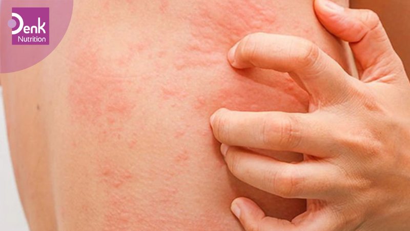 Tác dụng phụ của vitamin K với làn da